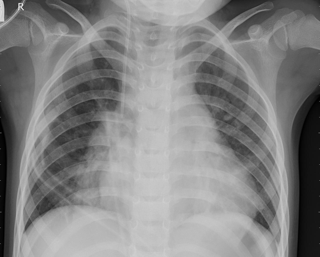 bacterial Pneumonia X-Ray