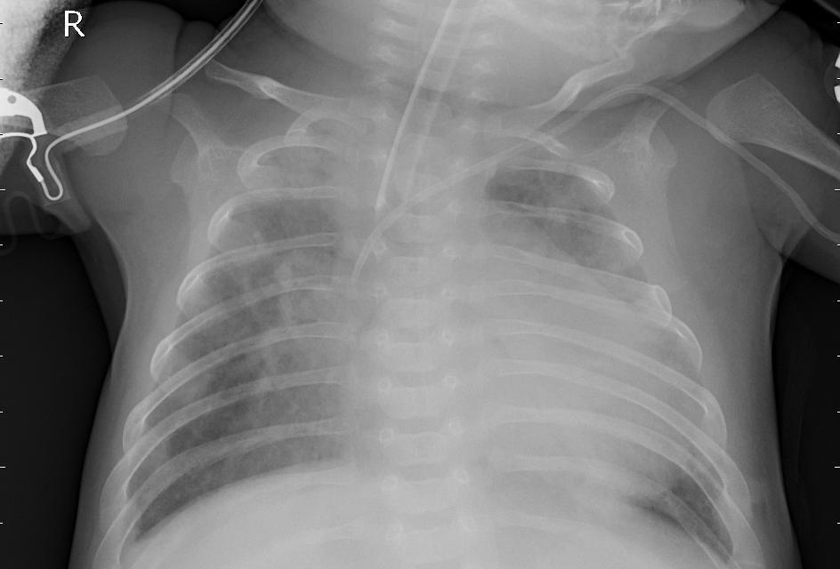 virus Pneumonia X-Ray